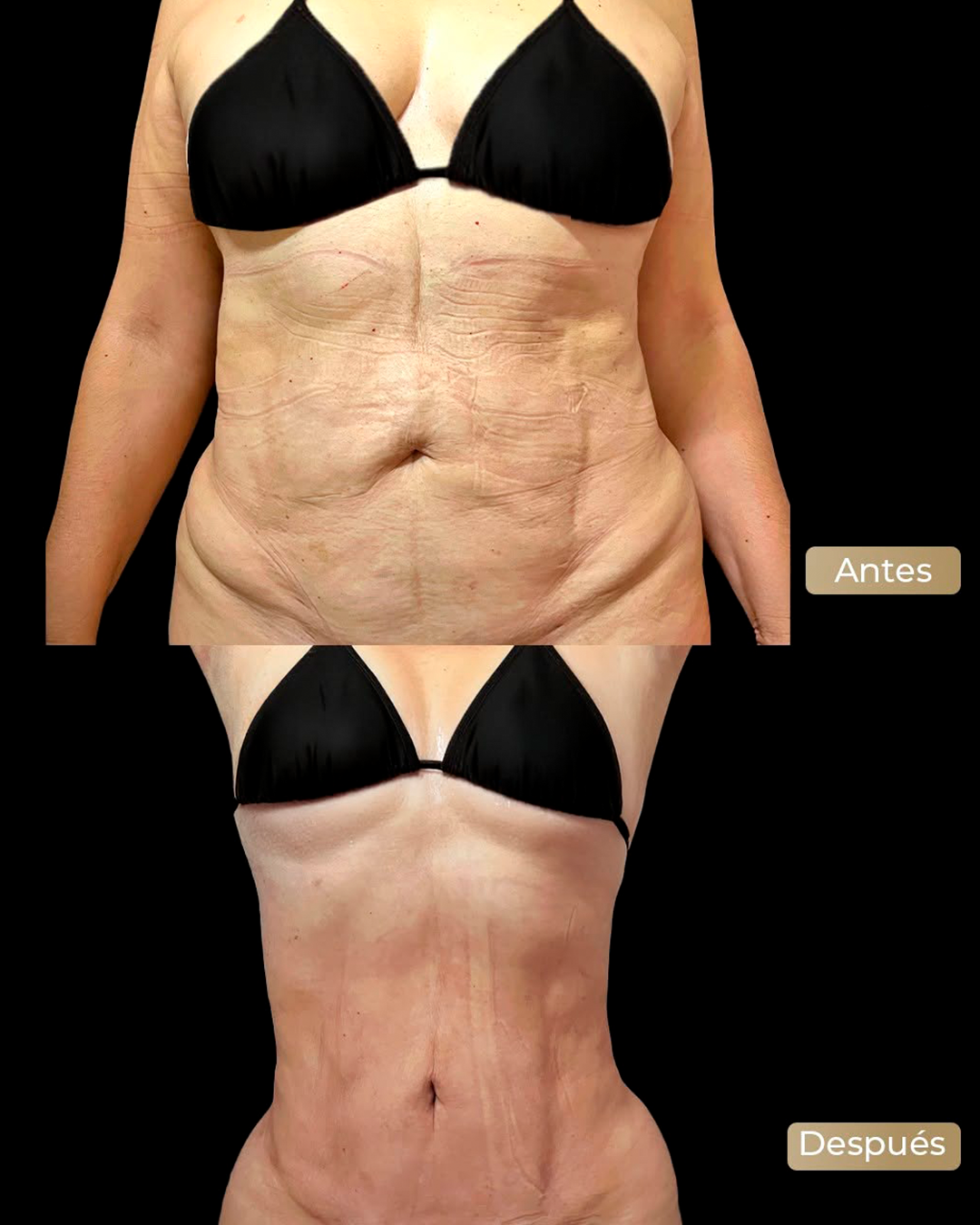 Procedimientos de cuerpo - Dr. Allen Mejía