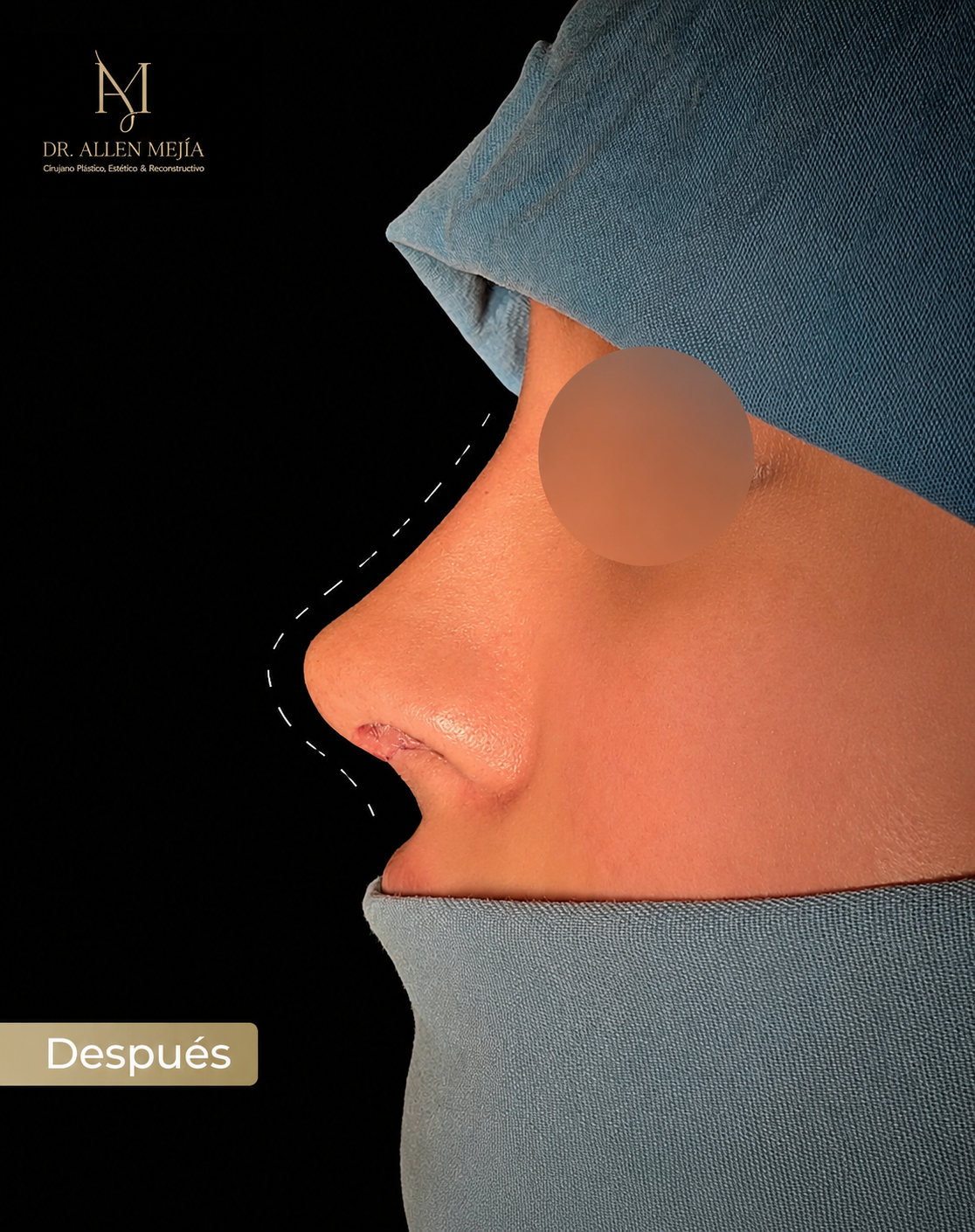 Resultado rinoplastia - vista protegida
