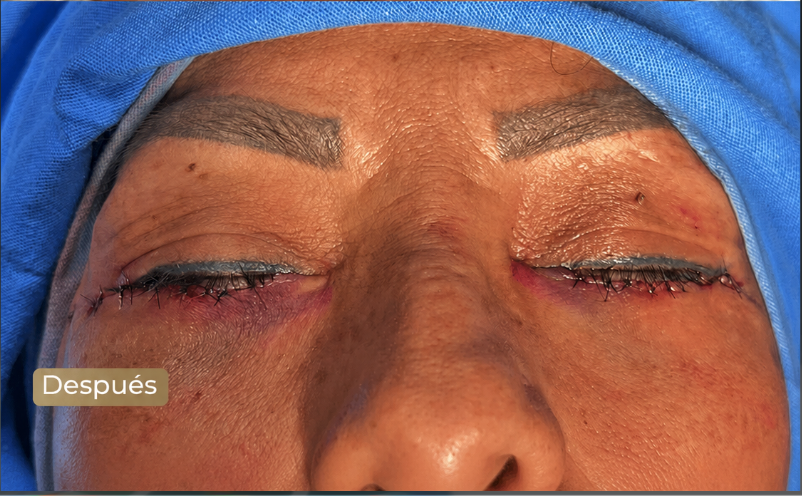 Resultado blefaroplastia - vista protegida