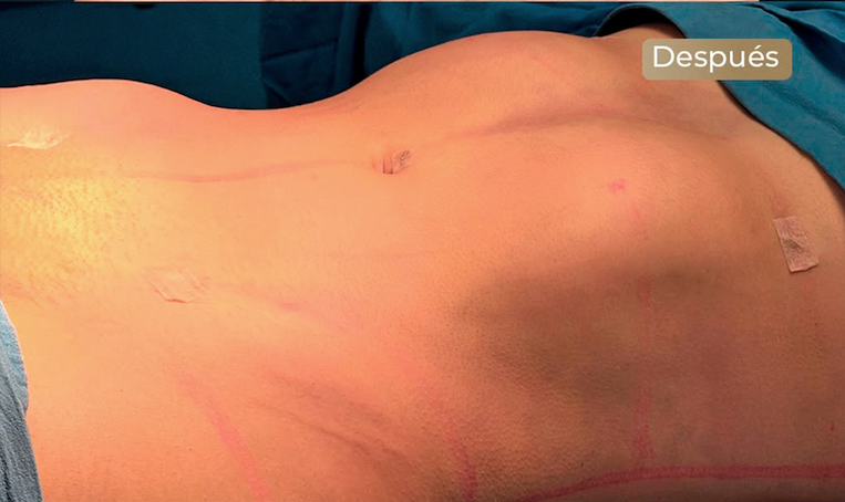 Resultado lipoescultura - vista protegida
